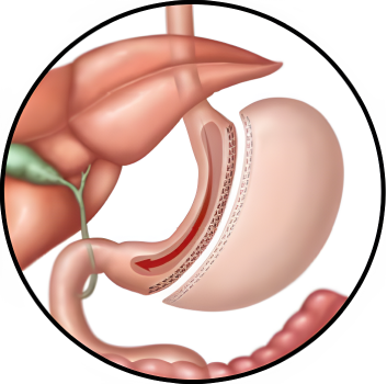 Video-cirugia-bypass_grande_pequena