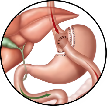 Video-cirugia-bypass_pequena